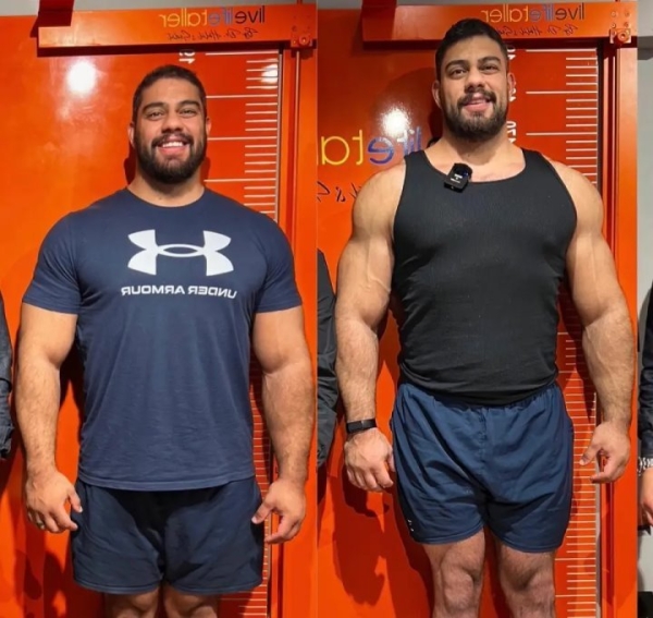 Мужчина потратил 100 тысяч евро, чтобы увеличить свой рост. «Вырос» до двух метров